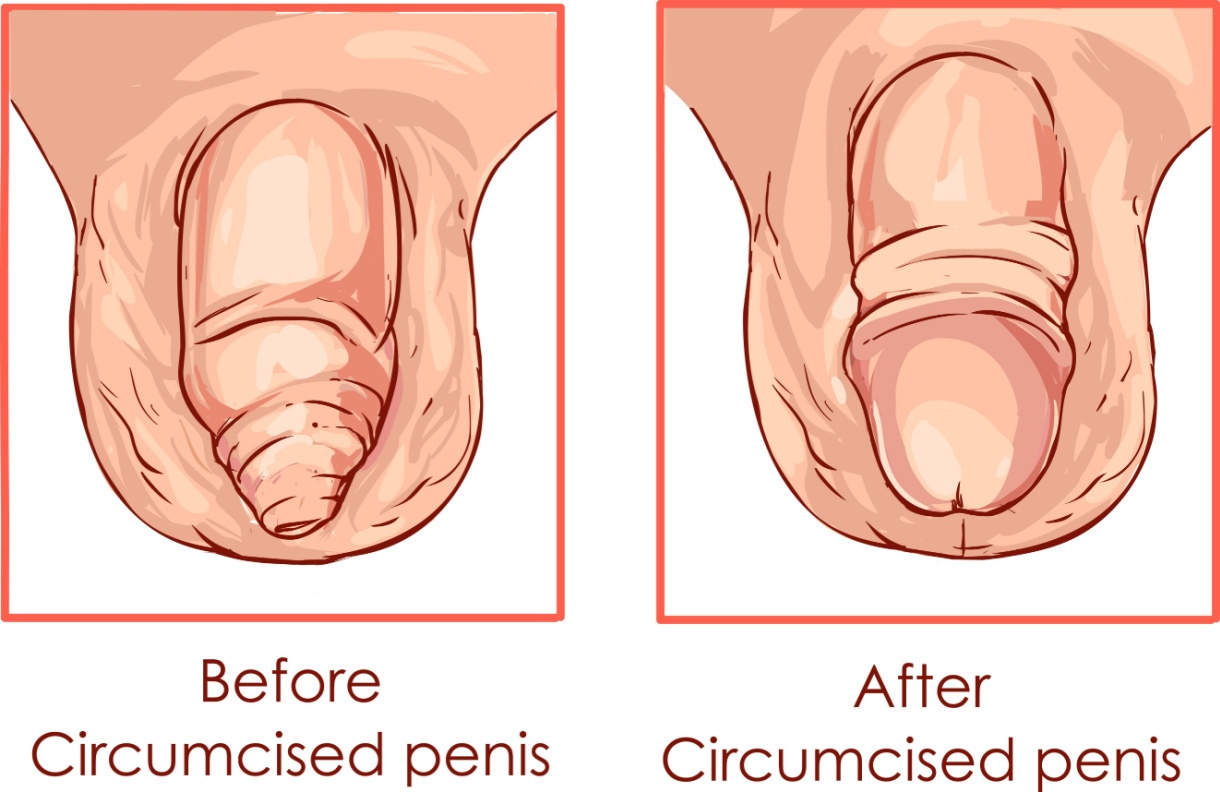 circumcision and your sex life all questions answered 1