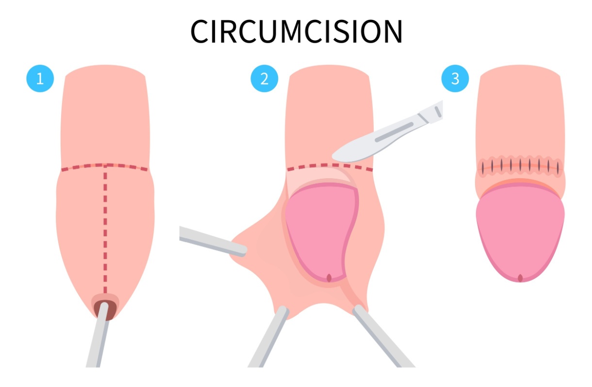 circumcision and your sex life all questions answered 9
