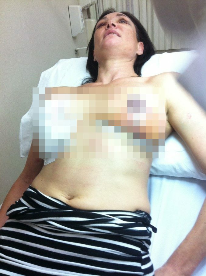 Plastic surgery gone wrong porn star edition 10 surgery6 blurred tmp